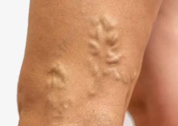 Tratamento de Escleoterapia com espuma densa