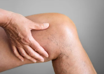 Tratamento de Escleoterapia liquida ampliada
